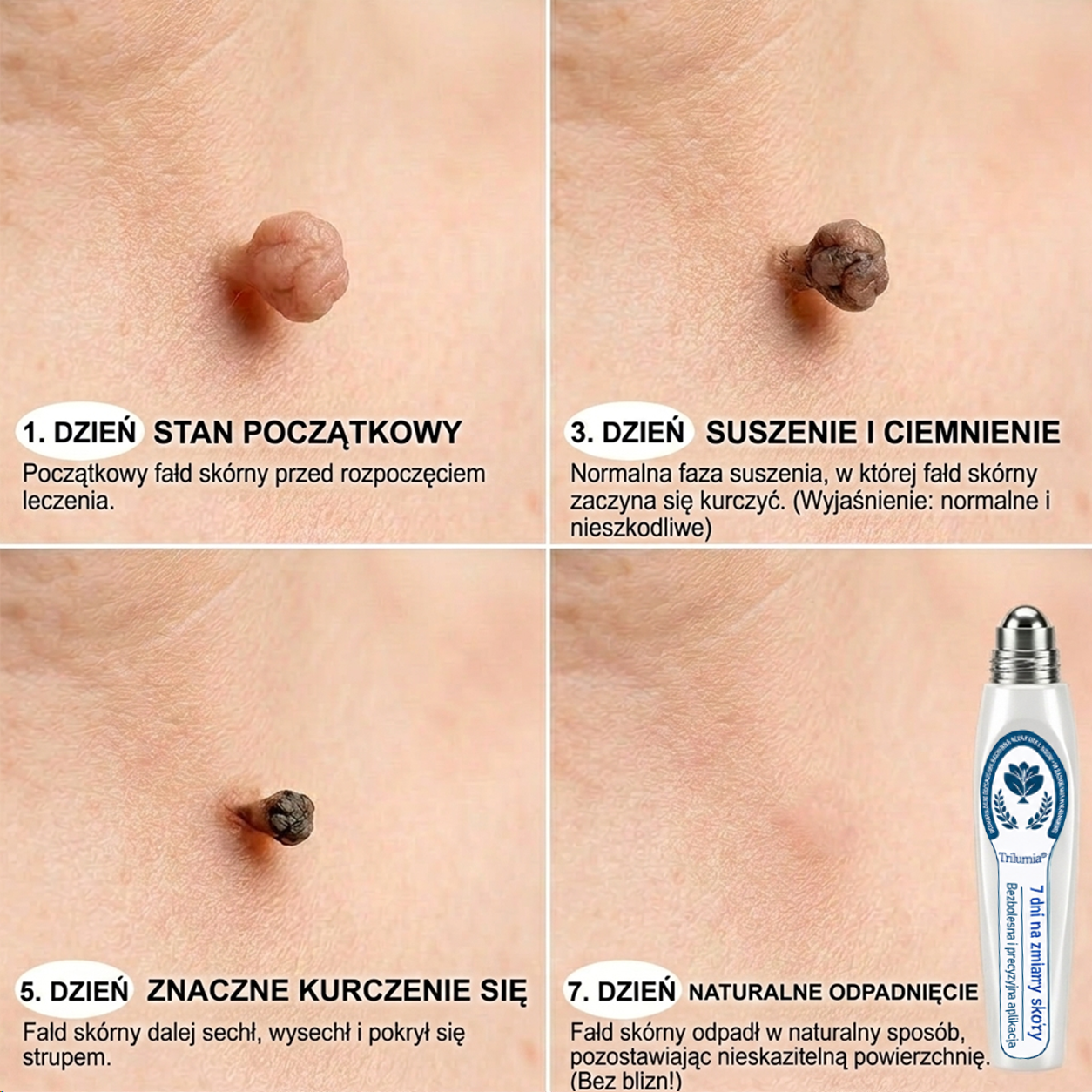𝐎𝐟𝐢𝐜𝐣𝐚𝐥𝐧𝐲 𝐬𝐤𝐥𝐞𝐩 𝐦𝐚𝐫𝐤𝐢 | ✅️ Trilumia® 7-dniowy preparat na narośle skórne i przebarwienia (bezbolesny aplikator roll-on, bez blizn) 😍