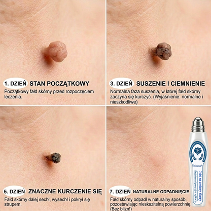 𝐎𝐟𝐢𝐜𝐣𝐚𝐥𝐧𝐲 𝐬𝐤𝐥𝐞𝐩 𝐦𝐚𝐫𝐤𝐢 | ✅️ Trilumia® 7-dniowy preparat na narośle skórne i przebarwienia (bezbolesny aplikator roll-on, bez blizn) 😍