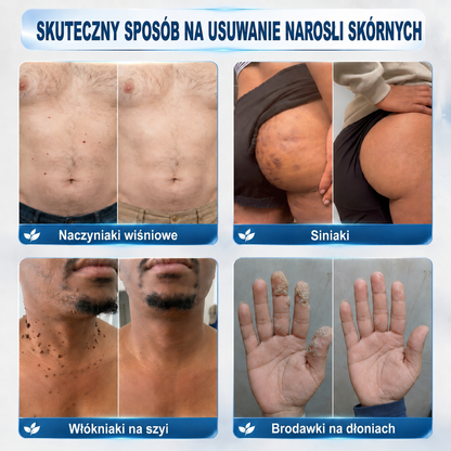 𝐎𝐟𝐢𝐜𝐣𝐚𝐥𝐧𝐲 𝐬𝐤𝐥𝐞𝐩 𝐦𝐚𝐫𝐤𝐢 | ✅️ Trilumia® 7-dniowy preparat na narośle skórne i przebarwienia (bezbolesny aplikator roll-on, bez blizn) 😍